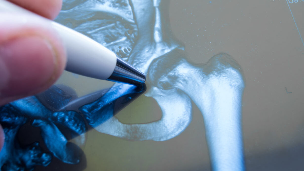 Types of Osteotomy Procedures Performed By A Neurosurgeon