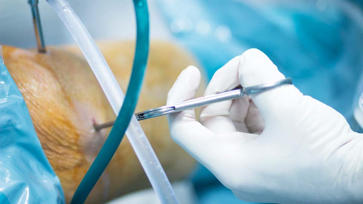 Need Knee Arthroscopy?