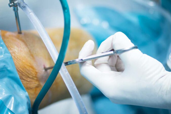 Need Knee Arthroscopy?