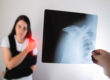 Treatment Options for a Dislocated Shoulder