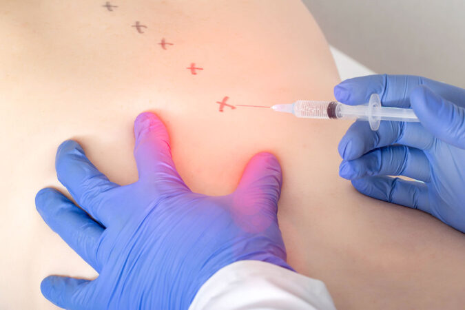 Can an Epidural Steroid Injection Work for Your Inflammation?