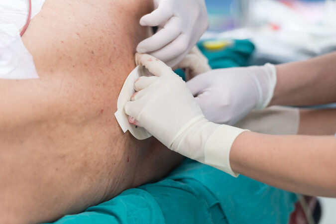 Side Effects Of Epidural Steroid Injections