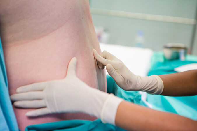 Why Are Epidural Steroid Injections Used for Post-Surgical Treatment?