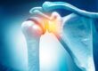 What is a Rotator Cuff Tear?
