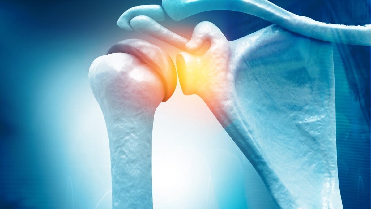 What is a Rotator Cuff Tear?
