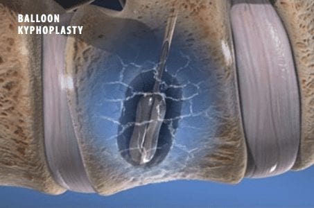 Kyphoplasty Kyphoplasty Surgery