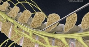 Spinal Cord Stimulate