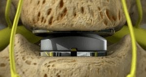 Artificial Disc Replacement Surgery Side Effects