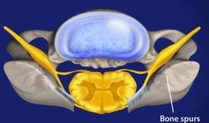 Where are bone spurs