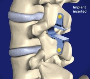 co flex surgery results