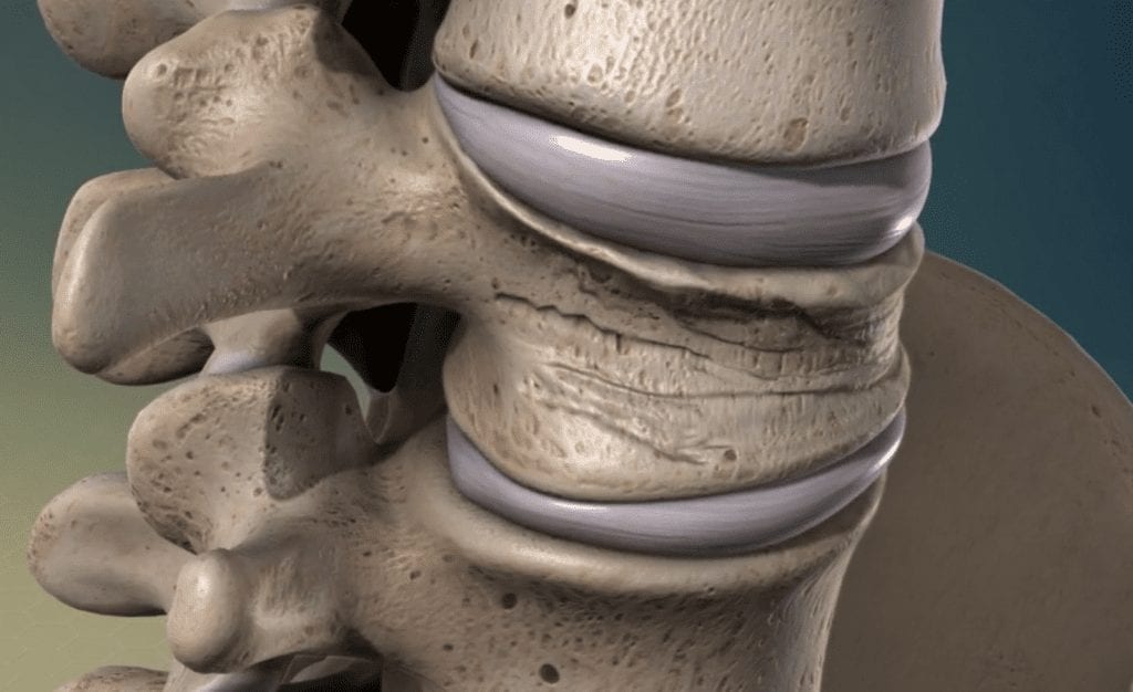 Is Degenerative Disc Disease Dangerous