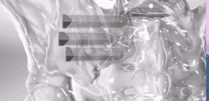 SI Joint Fusion photo