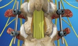 Spine Fusion photo