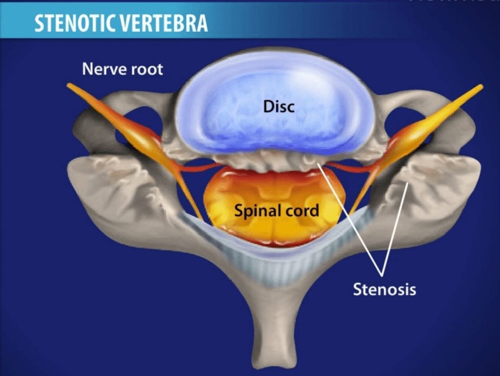 What causes Stenotic Vertebra