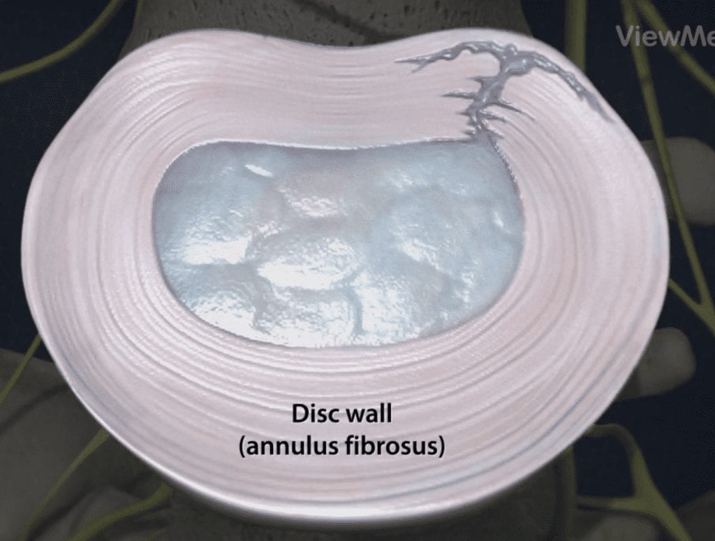 How serious is an Annular Tear