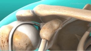 Bicep Tenodesis surgery