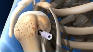 Biceps Tenodesis Surgery Photo