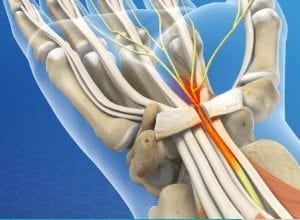 Carpal Tunnel Release pain