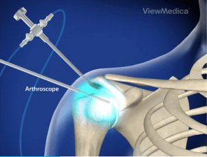 Diagnostic Arthroscopy Repair