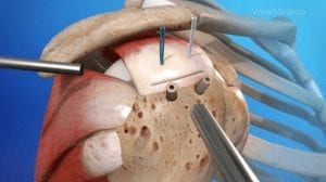 best Rotator Cuff Repair