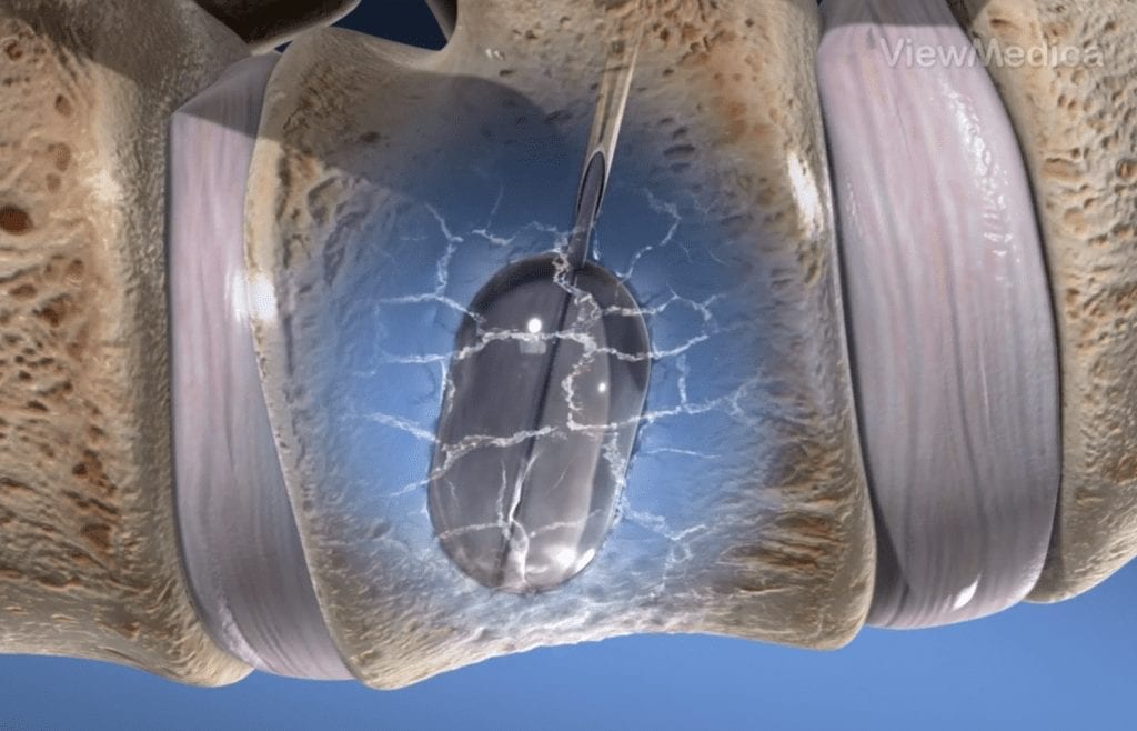 Kyphoplasty recovery