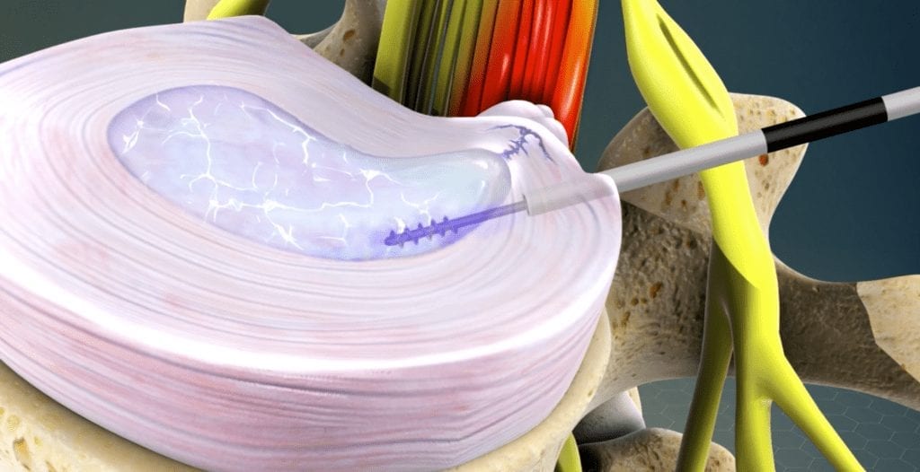 Percutaneous Disc Recovery Time