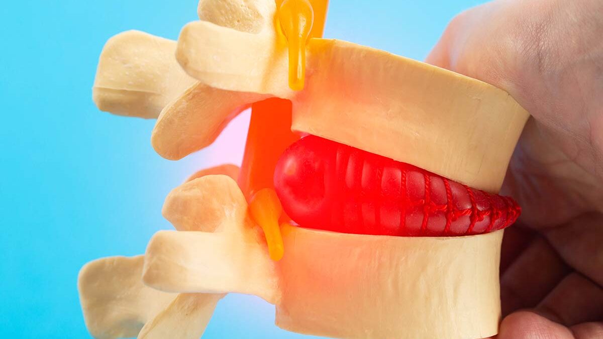 What To Expect After a Microdiscectomy