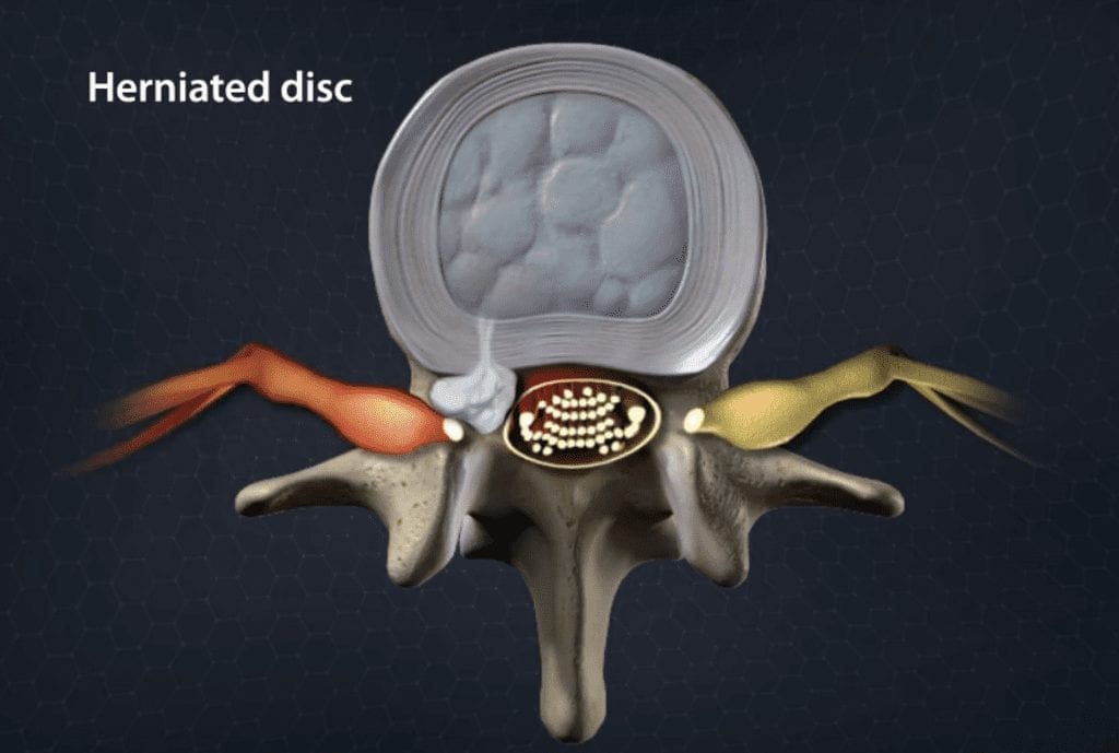 When do you need Herniated Disc Surgery?