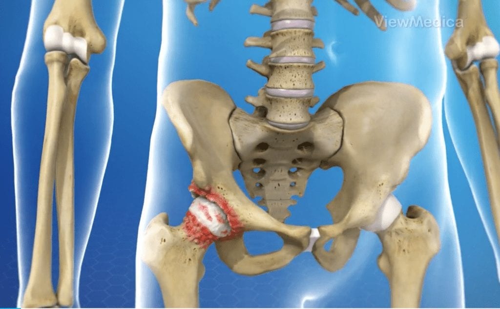 Hip Replacement Surgery
