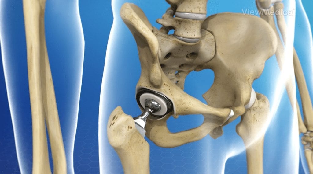 Hip implant