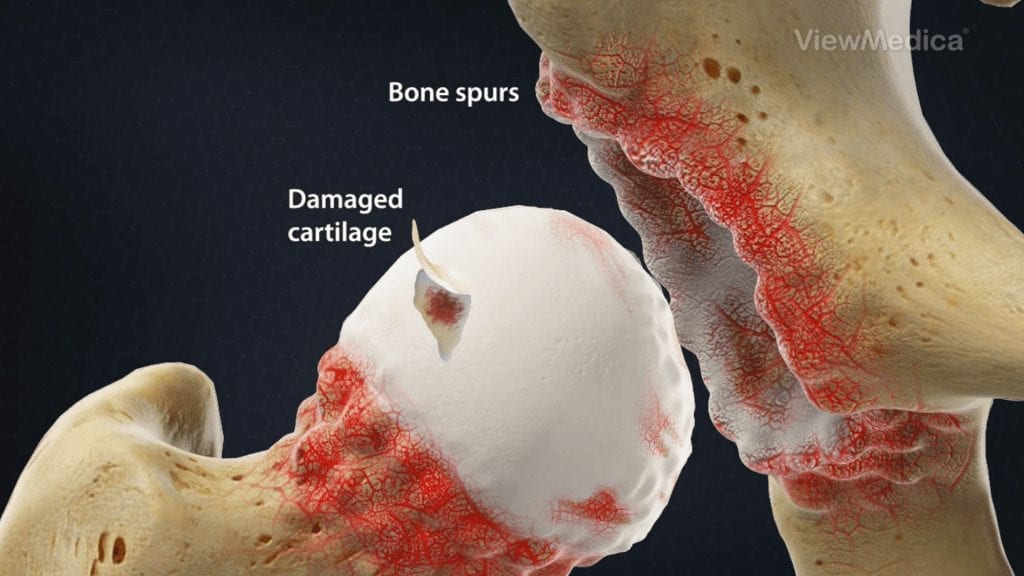 Hip Joint Damage