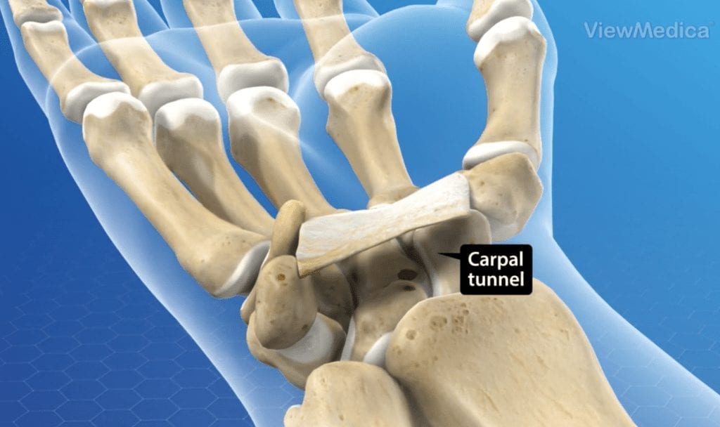 Carpal Tunnel