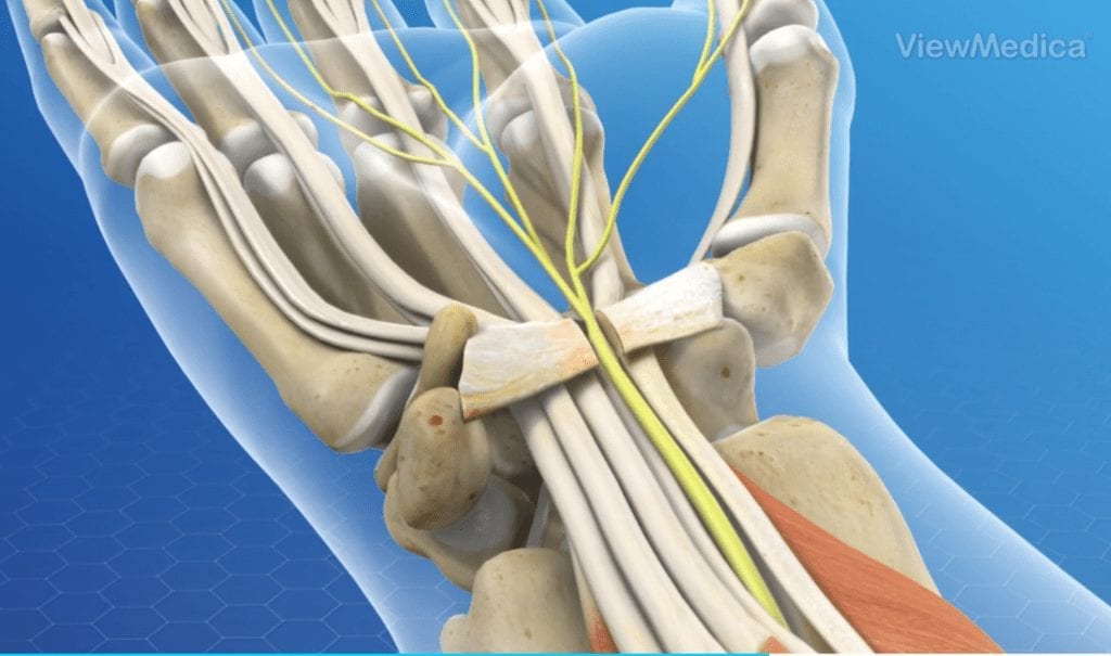 Carpal Tunnel Surgery