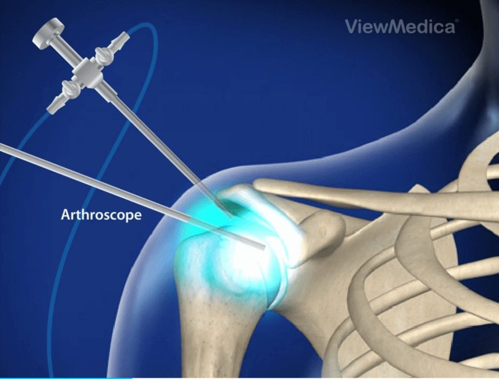 Diagnostic Arthroscopy