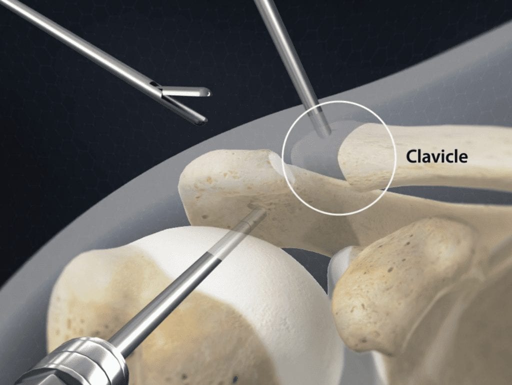 Distal Clavicle Surgery