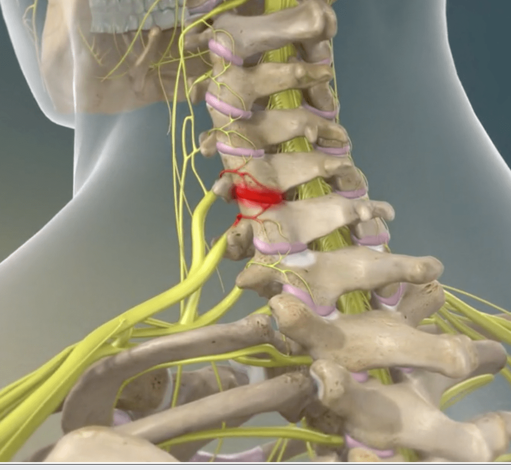 Radiofrequency Ablation