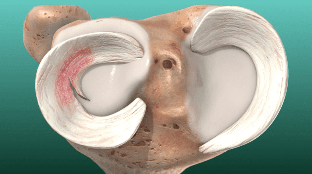 Torn Meniscus