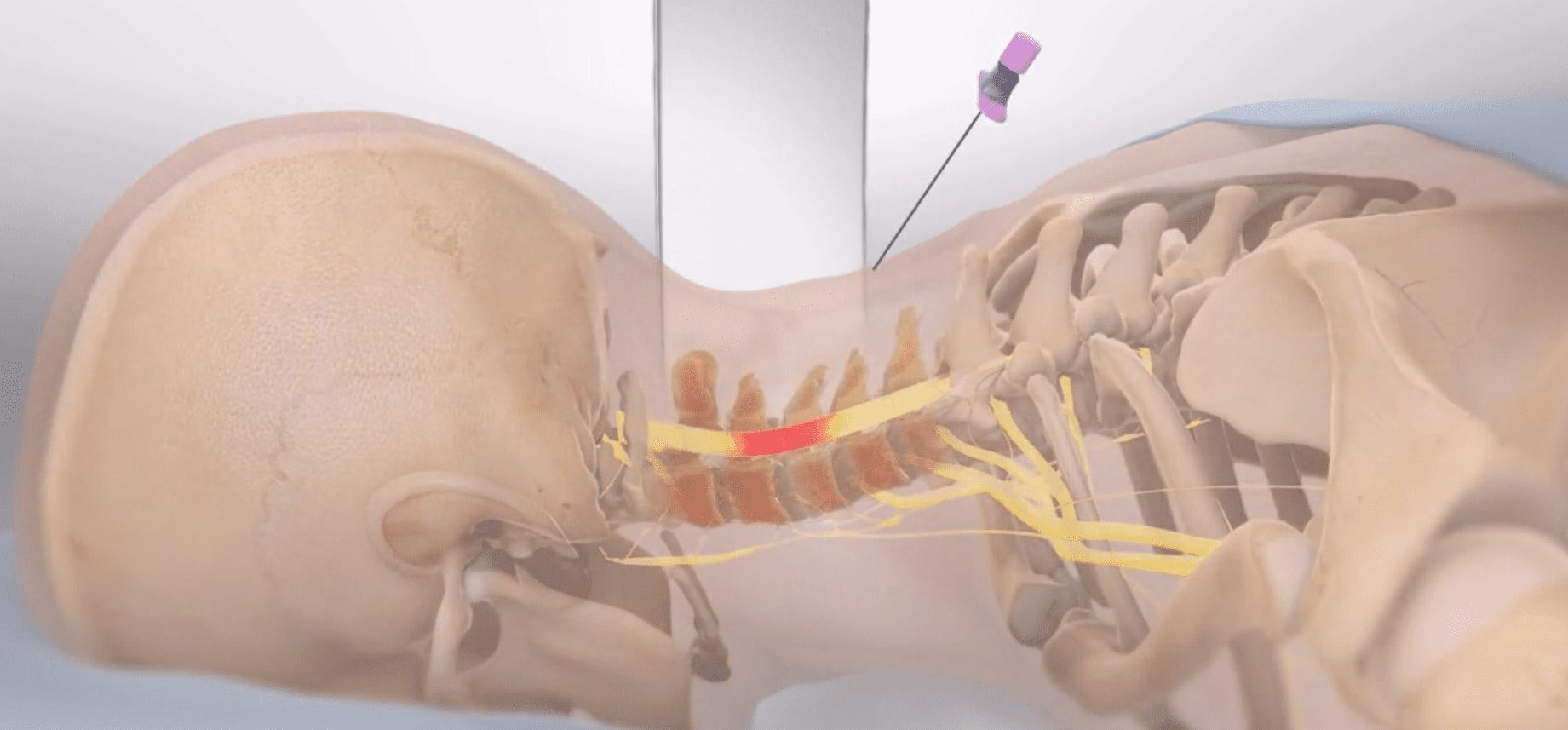 Epidural Steroid Injection in Neck