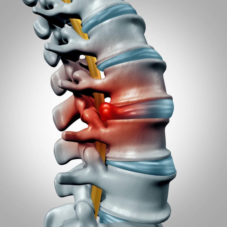 A pinched nerve causes pain in spine