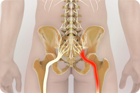 sciatica-img