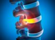 Understanding Herniated Discs: Symptoms, Conservative Care, and When Surgery Is Needed
