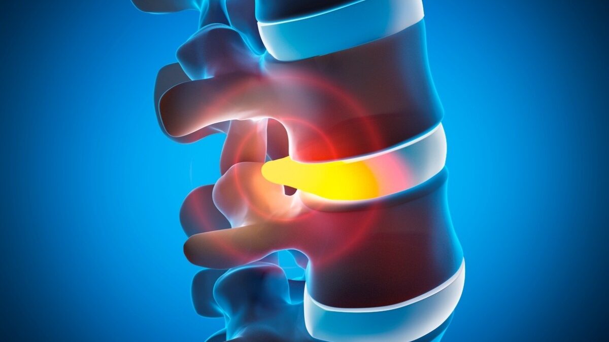 Understanding Herniated Discs: Symptoms, Conservative Care, and When Surgery Is Needed