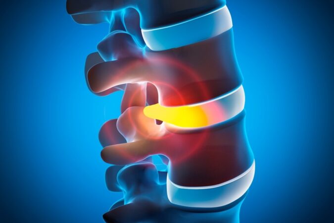Understanding Herniated Discs: Symptoms, Conservative Care, and When Surgery Is Needed