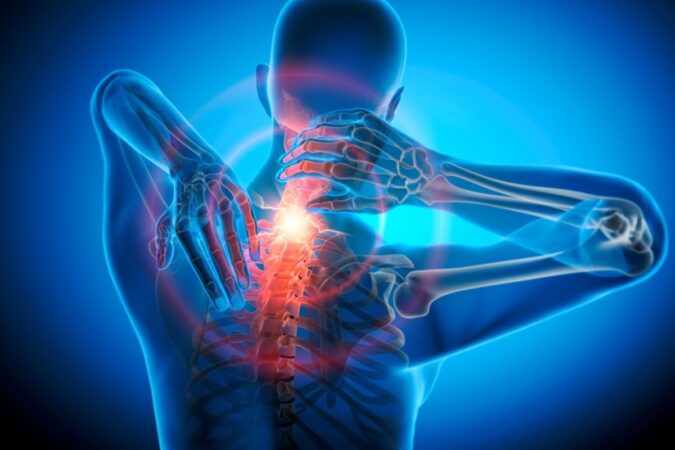 Do You Have a Pinched Nerve? Foraminal Stenosis Explained