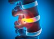 Do I Have a Slipped Disc?