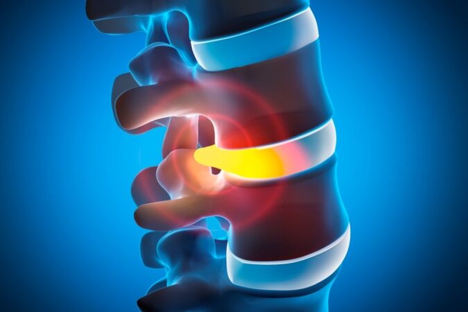 Do I Have a Slipped Disc?