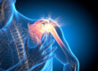 What's Causing Pain Between My Shoulder Blades?